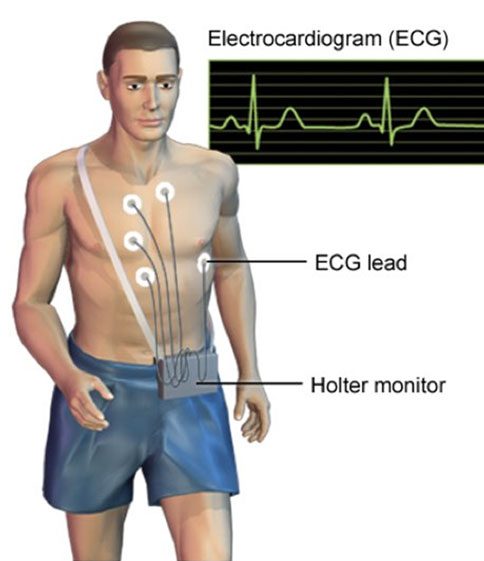 ecgのholterケーブル